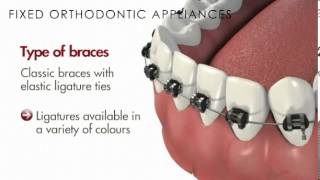 MalocclusionFixed Orthodontic AppliancesBraces [upl. by Nelson794]