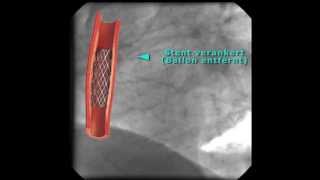 Kardiologie Wiederherstellung des Blutflusses bei Myokardinfarkt [upl. by Eimmac]