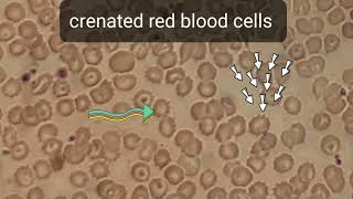 Crenation in blood film smear shows numerous of Burr cells or crenated red blood cells echinocytes [upl. by Aicsile]