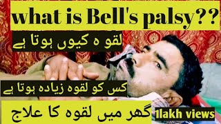 How to treat bells palsy causes signs and symptoms and exercisesUrdu Hindi [upl. by Akiaki704]