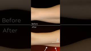 Arm fat Bingo Wing removal using coolsculpting shorts [upl. by Mccreary543]