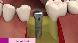 HiossenOsstem ETIII Implannt Placement with Taper Kit [upl. by Einnek]