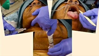 Complete Local Airway Anesthesia for Awake Intubation in 3 Minutes [upl. by Dirtsa672]