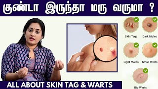 வலியே இல்லாமல் மருவை நிரந்தரமாக நீக்கலாம்  Warts Vs Skin Tags  Dr Shwetha Rahul Explains [upl. by Terraj]