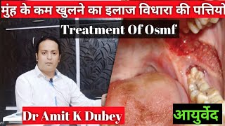 मुंह के कम खुलने का इलाज। 100ठिक । how to treat osmf case  oral sub mucous fibrosis [upl. by Adihaj155]