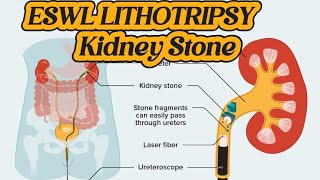 Operation of Lithotripsy  ESWL Lithotripsy  Kidney Stone Treatment  Renal DJ Stent [upl. by Bibi137]