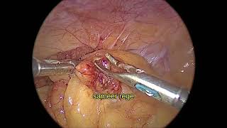 Laparoscopic excision of infarcted appendices epiploicae of sigmoid colon [upl. by Asaph844]