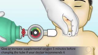 Changing a Tracheostomy Tube by J Nobrega M DeGrazia  OPENPediatrics [upl. by Coh]