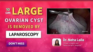 2022 Ovarian Cyst Signs and Symptoms  Scarless Laparoscopic Treatment  Dr Neha Lalla [upl. by Boykins314]