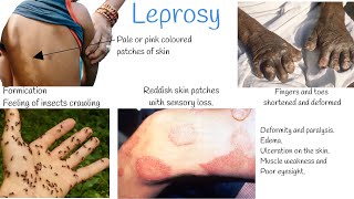 Leprosy signs and symptoms Treatment Hansens Disease [upl. by Htidirrem]