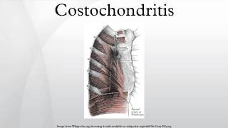 Costochondritis [upl. by Belva672]