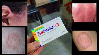 Allegra Tablet Fexofenadine 120 mg Use Dose Side Effects and Price in bengali [upl. by Noiroc]