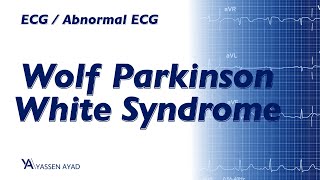 ECG 34  Wolf Parkinson white syndrome WPW [upl. by Ecineg608]