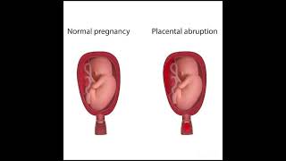 placenta previa  Abruptio placenta [upl. by Camile]