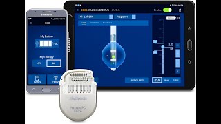 Deep brain stimulation  Percept Neurostimulator [upl. by Nosyarg395]