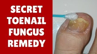 Secret ToeNail Fungus Home Remedy  Vicks VapoRub [upl. by Etom]