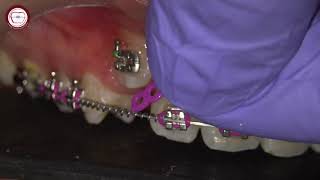 Dracula canine traction in orthodontics [upl. by Etteyafal]