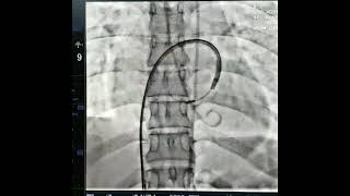 Successful Percutaneous Mitral Balloon Valvotomy of Patient With Tight Mitral Stenosis [upl. by Llig]