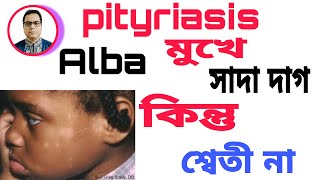 pityriasis Alba  মুখে সাদা দাগ। কিন্তু শ্বেতী না। জেনে নিন কি। কারণ ও চিকিৎসা। [upl. by Clarke]