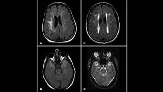 Cerebral Autosomal Dominant Arteriopathy with Subcortical Infarcts and Leukoencephalopathy [upl. by Latashia393]