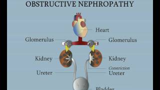 Ureteropelvic Junction  Obstructive Nephropathy [upl. by Nicolette399]