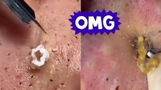 Top Acne Scar Treatments Proven Methods to Clear Your Skin Fast [upl. by Itin]