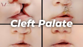 Why Cleft Palates Occur A Scientific Explanation [upl. by Atsyrhc]