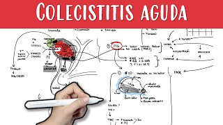 COLECISTITIS AGUDA colecistitis colelitiasis coledocolitiasis colico biliar murphy [upl. by Airretal]