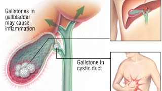 Cholecystitis [upl. by Paulsen]