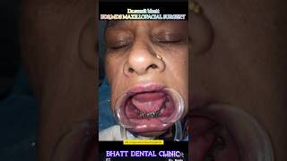 Fix teeth in 5 days ytshorts dental implantsurgery maxillofacialsurgeon [upl. by Audre811]