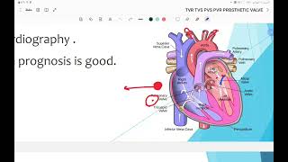 valvular heart disease [upl. by Dj]