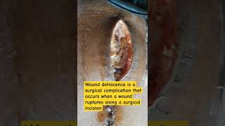 Wound Dehiscence in midline incision post emergency Laparotomy Surgery [upl. by Ball]