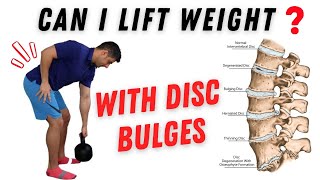 Can you lift weight in the gym with disc bulges [upl. by Ahsaek]