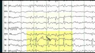 Focal EEG Abnormalities 1 [upl. by Annez882]