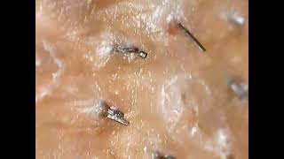 Ingrown hairs plucking [upl. by Drofhsa]