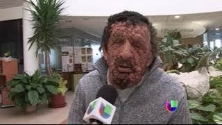 Hombre desfigurado contó qué le dijo el Papa cuando lo abrazó  Noticiero Univisión [upl. by Alfreda]