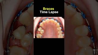 Braces time lapse Before and after transform braces orthodontist bracesoff dentist [upl. by Nannerb]