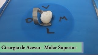 Molar Superior  Cirugia de Acesso [upl. by Frankel]