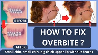 HOW TO FIX OVERBITE  SMALL CHIN BIG THICK UPPER LIP  WITHOUT BRACES NATURALLY [upl. by Swor]