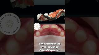 Invisalign Palatal Expander Skeletal expansion for growing patients [upl. by Davine]