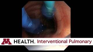 Easy Blocker Placement for Single Lung Ventilation [upl. by Ahtebbat]