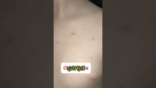 Chicken Pox Signs amp Symptoms  Lakra Kakra ki ilamat  Know the Risks amp Prevention [upl. by Nnalorac]