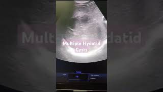 Multiple Hydatid Cysts Liver [upl. by Arahahs]