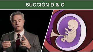 Aborto Quirúrgico durante el Primer Trimestre Succión D amp C Dilatación y Curetaje [upl. by Arva]