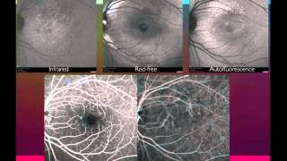 Longterm followup of 577 nm micropulse laser for central serous chorioretinopathy  Dr Andre Maia [upl. by Ardnosal765]