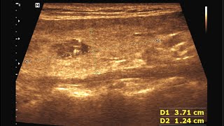 Thyroid Gland Nodule  Colloid Cyst [upl. by Aicatsal363]