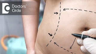 What is Tumescent Liposuction  Dr Ranganath [upl. by Almeria]