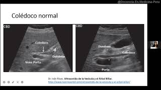 Ecografía de colédoco [upl. by Hegyera910]