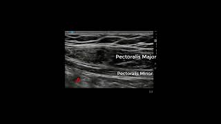 Pectoralis Minor Injection for Thoracic Outlet Syndrome [upl. by Ovatsug200]