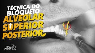 Anestesia por bloqueio do nervo alveolar superior posterior [upl. by Zetnom]